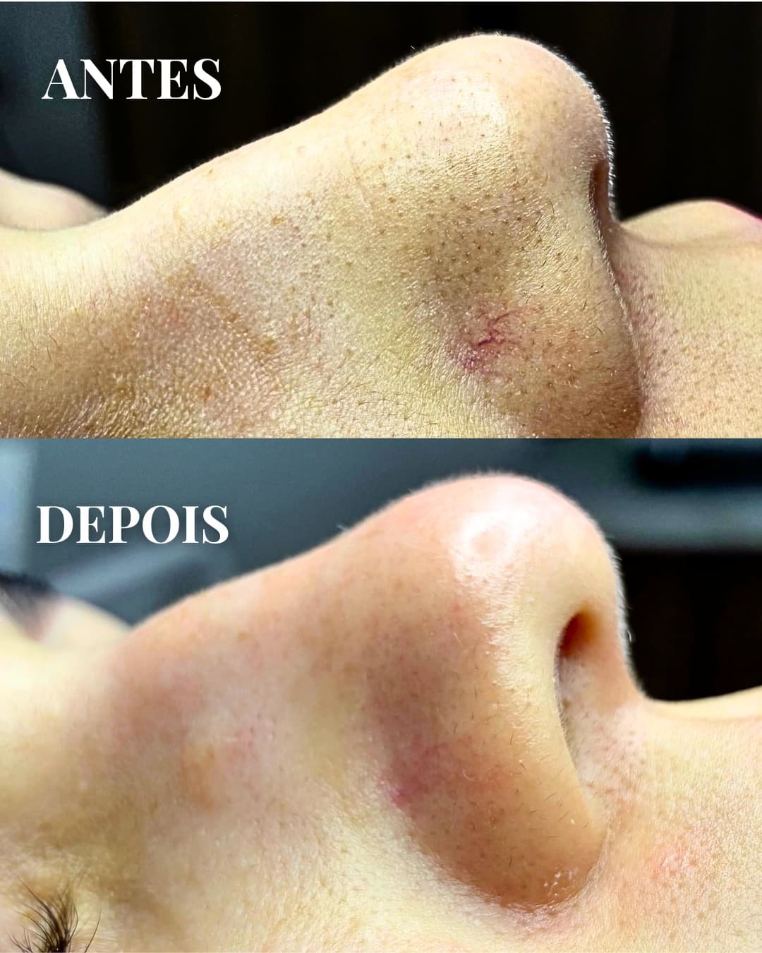 Antes e Depois Limpeza de Pele